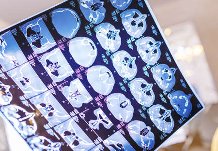 x-ray film of the head computed tomographyの写真素材