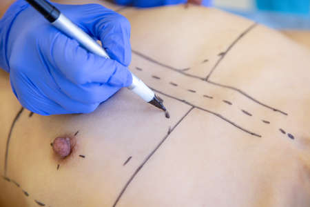 Plastic Surgery. Closeup Of Naked Woman Body With Black Surgical Marks On Her Breast. Closeup Of Doctor Hands Drawing Lines On Female Breast Before Breast Augmentation Operation.の写真素材
