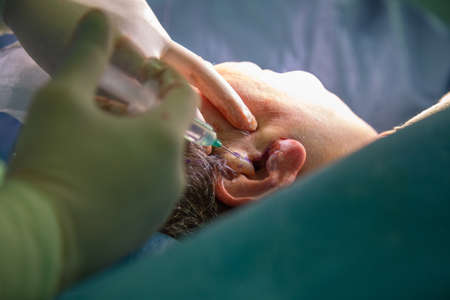 Plastic surgery in operating room. Circular face liftの写真素材