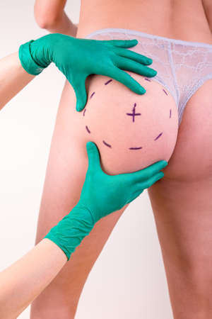 Surgeon drawing marks on female body before plastic operation, white background. Beautician touch and draw correction lines on womans buttocks. Liposuction conceptの写真素材