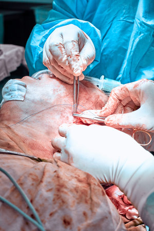 Facial plastic surgery operation. Face lift surgery. Surgeon separated the skin from the patients...