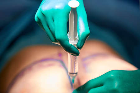 Hands of the doctor close up during the operation, in the hands of a syringe that makes an injection in the patients area. A surgeon performs surgery in a hospital operating room.の写真素材