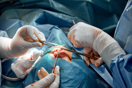Rhinoplasty close-up of nose surgery. The hands of the surgeon working tools in white gloves