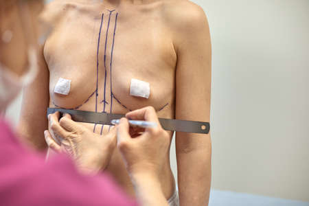 Middle-aged woman with correction for plastic surgery. The surgeon makes a markup of the patient before surgery. Palestinian surgery, beauty, health.の写真素材