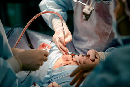 Rhinoplasty men, the surgeons gloved hands hold the instruments during nose surgery. Doctor in gloves holds a medical instrument during rhinoplastyの写真素材