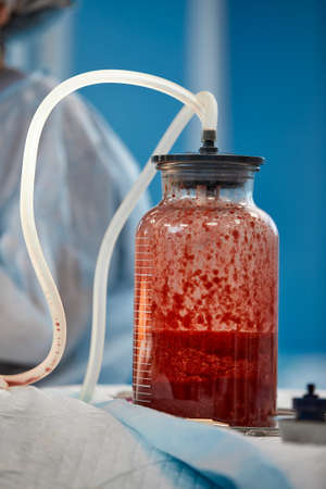 Plastic surgery to remove excess fat. Pumping fat into a jar during liposuction. Clinic of aesthetic surgery.の写真素材