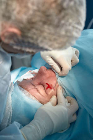 Close up of the face of a patient who is undergoing blepharoplasty. The surgeon cuts the eyelid and performs manipulations using medical instrumentsの写真素材