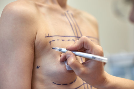 Breast Augmentation. Closeup Beautician Hands Drawing Surgical Lines On Woman Breast. Female Body With Black Marks On Breasts Before Plastic Surgery Operationの写真素材