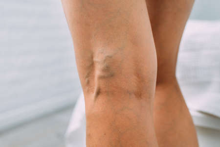 Legs with woman with varicose veins and pronounced mesh.の写真素材
