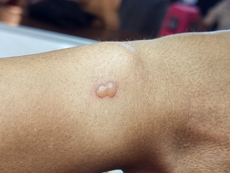 The skin on the arm of an Asian man is blistered and inflamed, a poisonous insect bite