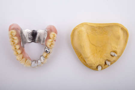 model of the jaw with a prosthesis on a white backgroundの写真素材