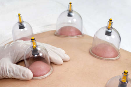 Multiple cup of medical cupping therapy on human bodyのeditorial素材