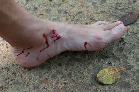 Man's bloody foot close-up. Leech bite after-effect.の写真素材