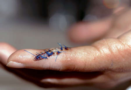 Stitches on a finger laceration.の写真素材