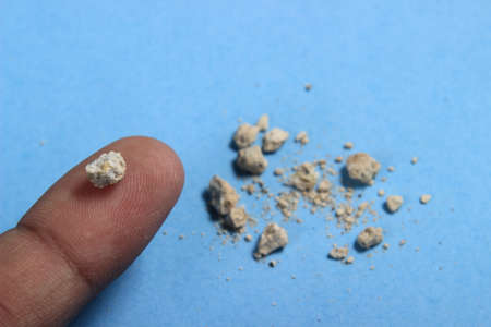flat lay or top view very small kidney stone at finger at blue background