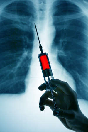 A radiograph and a syringe. Example picture of illness.の写真素材