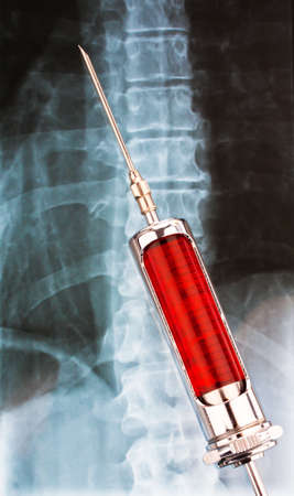 A radiograph and a syringe. Example picture of illness.の写真素材
