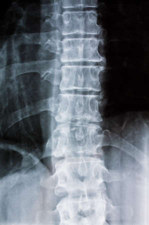 X-ray of a spine. Photo icon for health and disease.の写真素材