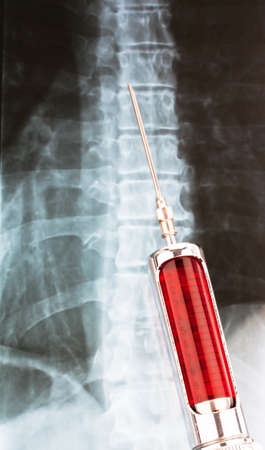 hypodermic needle and syringe in front of a radiographの写真素材