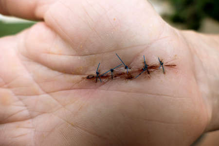 seam on one hand for a carpal tunnel syndromeの写真素材
