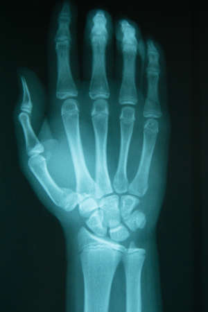 film x-ray hand : show normal human's hands on black backgroundのeditorial素材