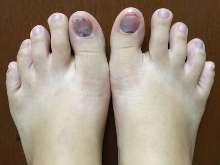 Injured of foot purple bruise toenail, close up view on wooden floorの写真素材