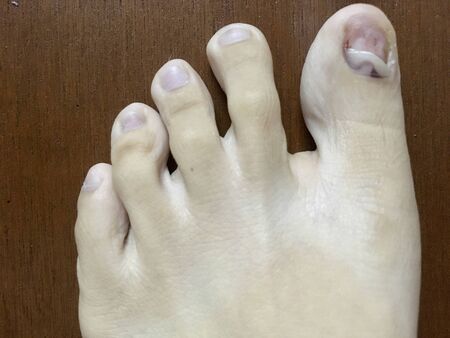 Injured of foot was cut purple bruise toenail, close up view on wooden floorの写真素材