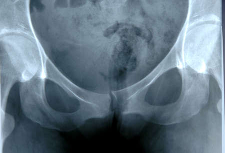 X-Ray of human pelvis showing hip bones and abdominal area.の写真素材