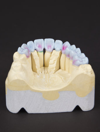 closeup for a mock up of a dental circular bridgeの写真素材