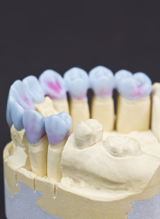 closeup for a mock up of a dental circular bridgeの写真素材