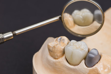 closeup for a ceramic dental crown for a molar teeth on a cast modelの写真素材