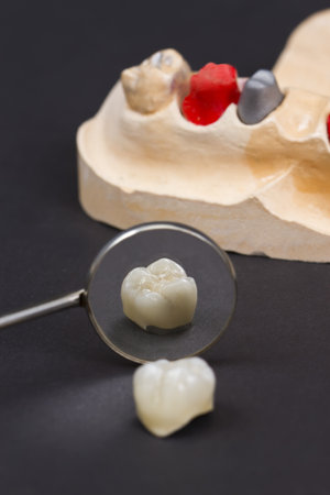 closeup for a ceramic dental crown for a molar teeth on a cast modelの写真素材