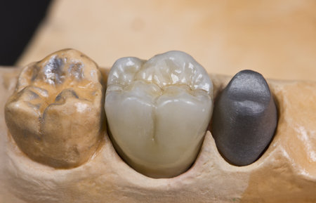 closeup for a ceramic dental crown for a molar teeth on a cast modelの写真素材