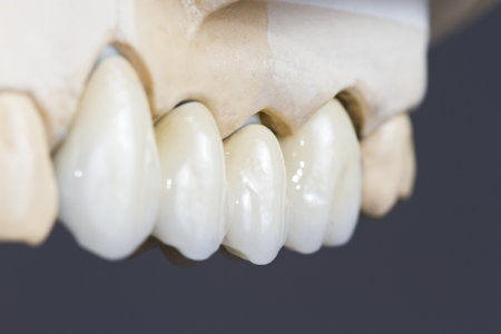closeup for a dental ceramic bridge ona  cast modelの写真素材