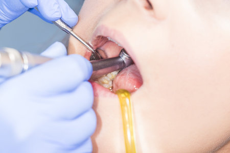 Steps of filling a teeth  at dentist's office.の写真素材