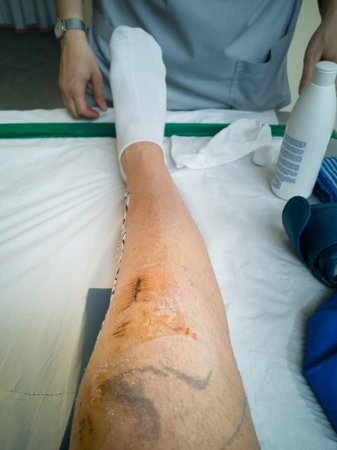 Knee Injury after Stitches have been removed  After Knee Surgery.