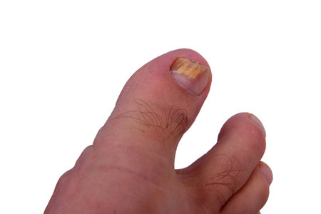 Nail fungus infection on big toe. Fungal infection on fingernails toe with ringworm onychomycosis,...