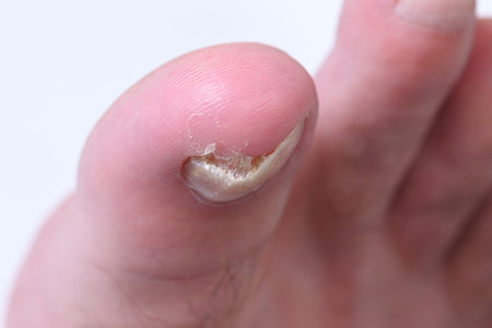 mycosis Fungal infection of the big toe nails. Fungal infection of toenails with ringworm onychomycosis, heat dry skin infection disease results medicinalの写真素材