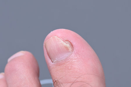 mycosis Fungal infection of the big toe nails. Fungal infection of toenails with ringworm onychomycosis, heat dry skin infection disease results medicinalの写真素材