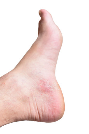 Skin condition with dyshidrotic eczema on the foot against a white background. Example of allergic contact dermatitis: red, itchy rash.の写真素材
