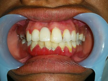 Front view of the oral cavity with dental calculus and dental plaque on cervical of the teeth, tooth caries in proximal teeth.の写真素材