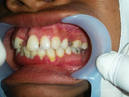 Side view of the oral cavity with dental calculus and dental plaque on cervical of the teeth, tooth caries in proximal teeth.の写真素材