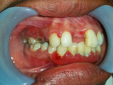 Side view of the oral cavity with dental calculus and dental plaque on cervical of the teeth, tooth caries in proximal teeth.の写真素材