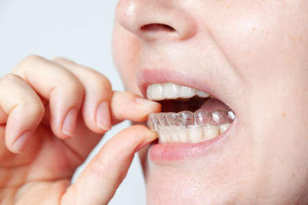 A woman gently puts a plastic retention cap on her lower teeth with her fingers. Woman face and mouth close-up on a gray backgroundの写真素材