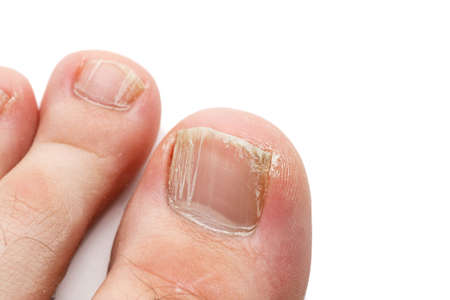 爪水虫の写真・イラスト素材一覧(2,618件) ストックフォトの