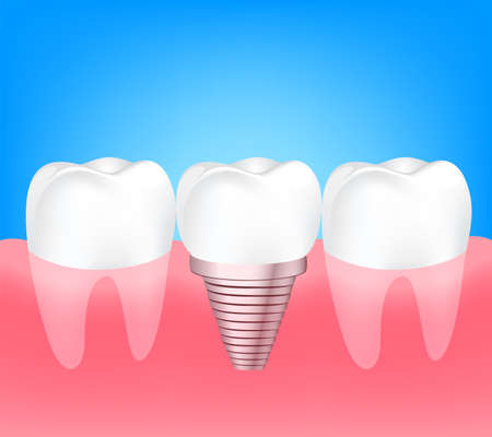 Two healthy teeth and implant tooth between. Human tooth implant concept. Illustration on blue...