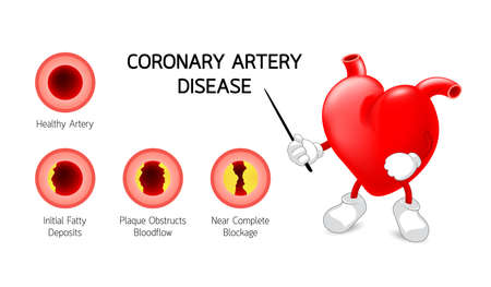 Cute heart character with Coronary Artery Disease infographic. Heart awareness concept. Atherosclerosis stages.のイラスト素材