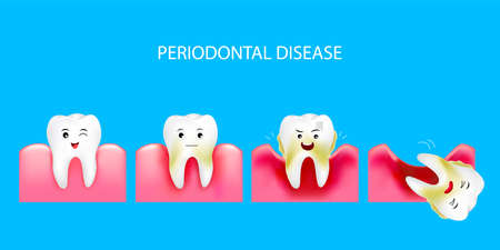 Step of periodontal disease. Healthy tooth and gingivitis. Dental care concept. Illustration isolated on blue background.のイラスト素材