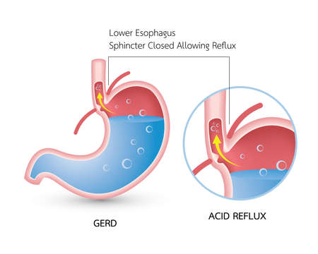 Gastroesophageal reflux disease (GERD). Acid reflux, heartburn and gerd infographic with stomach medical illustration, symptoms, causes and preventionのイラスト素材