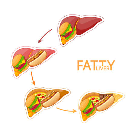 Step of unhealthy food in shape of liver. Fatty liver awareness concept.  Vector illustration isolated on white background.のイラスト素材